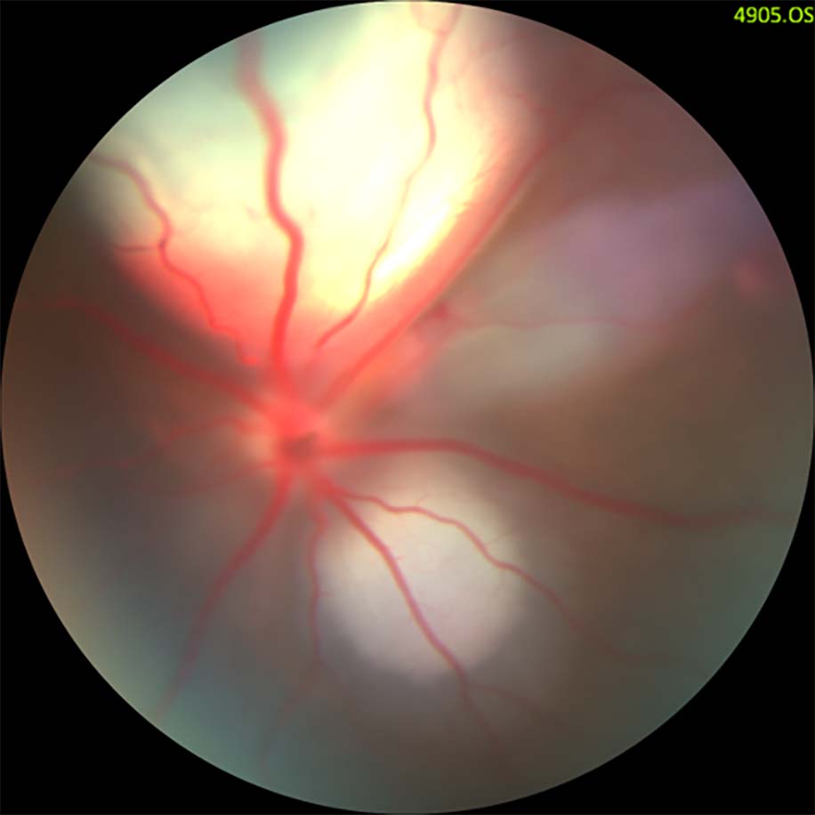 Choroidal Neovascularization CNV Model Ichor Life Sciences