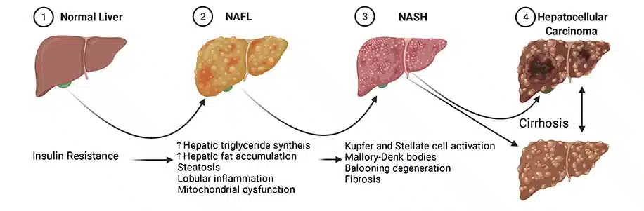 Ahmed N R, Kulkarni V, Pokhrel S, et al. (May 08, 2022) Comparing the Efficacy and Safety of Obeticholic Acid and Semaglutide in Patients With Non-Alcoholic Fatty Liver Disease: A Systematic Review. Cureus 14(5): e24829. doi:10.7759/cureus.24829