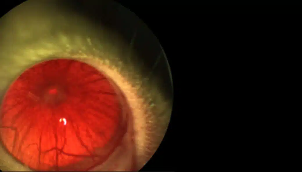 Uveitis-Eye-2-1-1