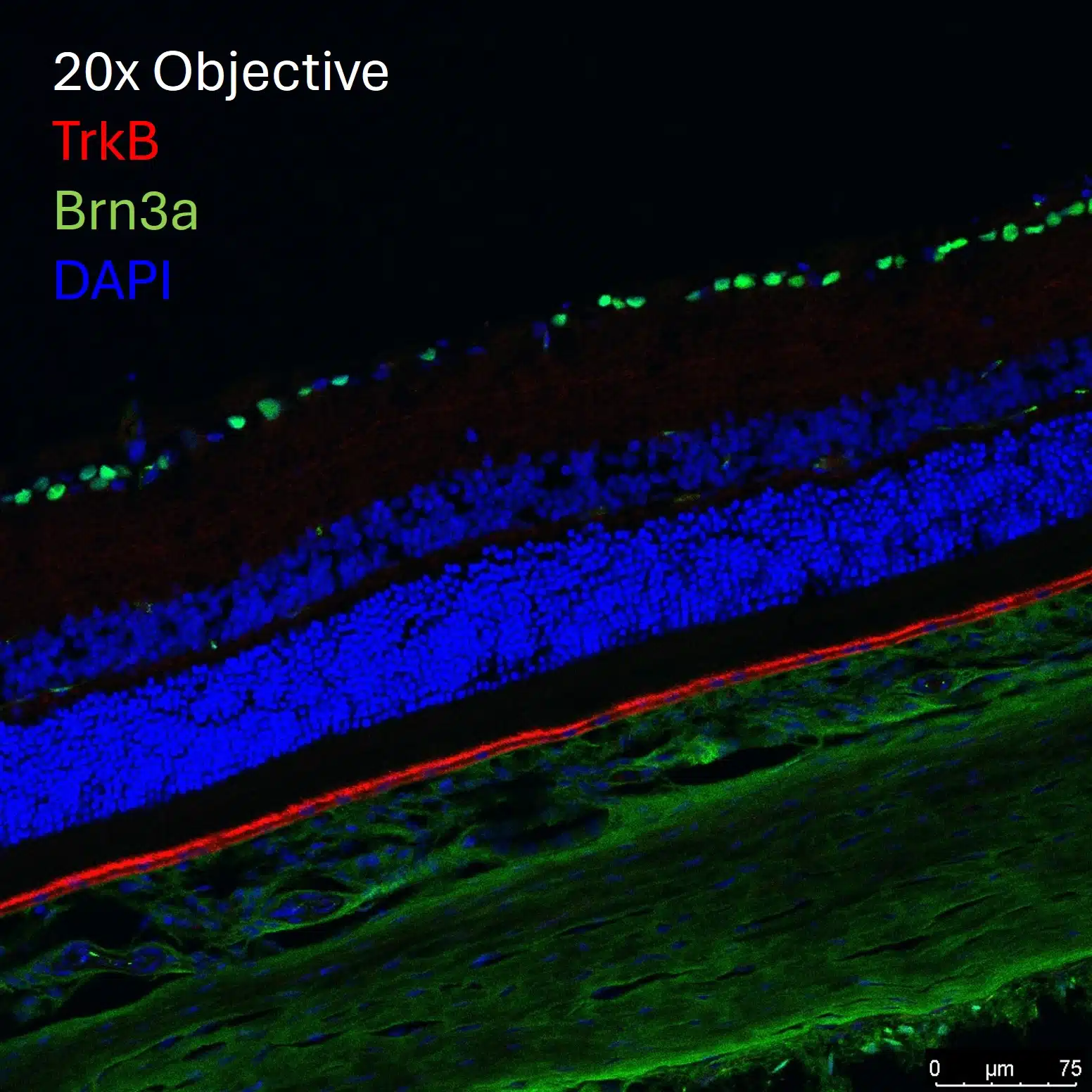 glaucoma_histology