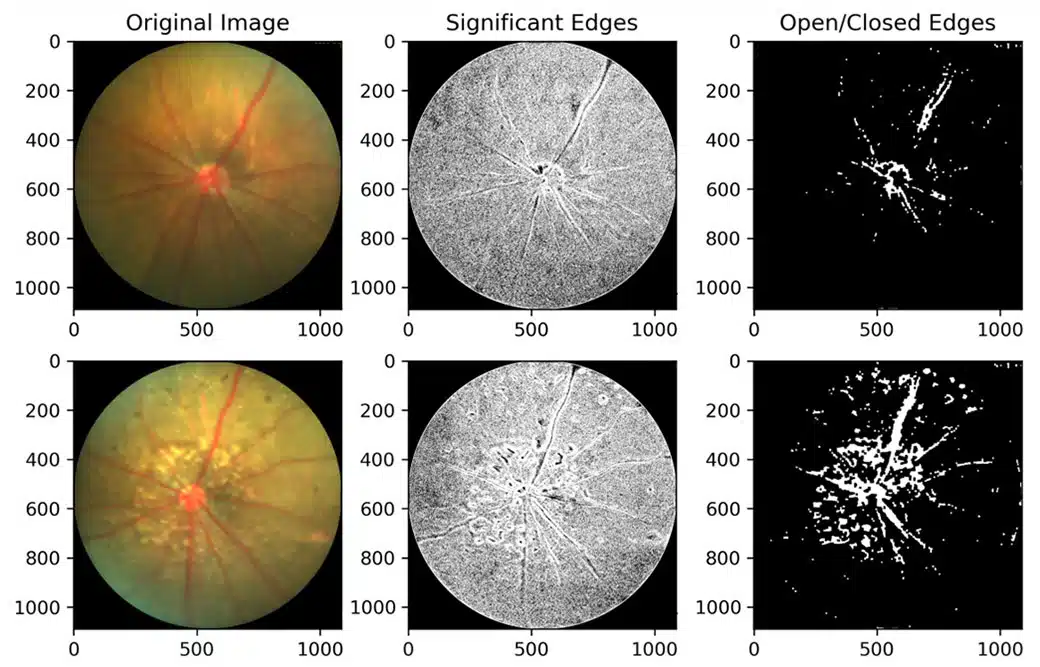 naio3_fundus_quantification_algorithm@2x